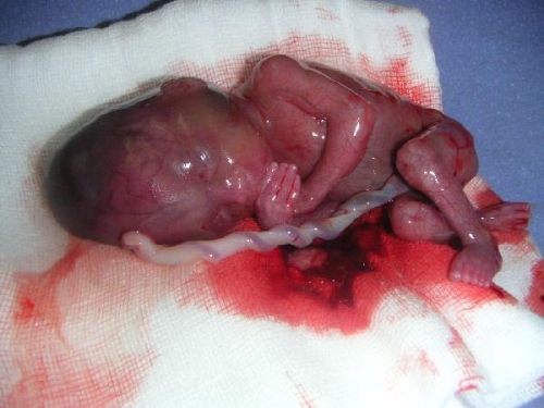 aborto.jpgmid.jpg